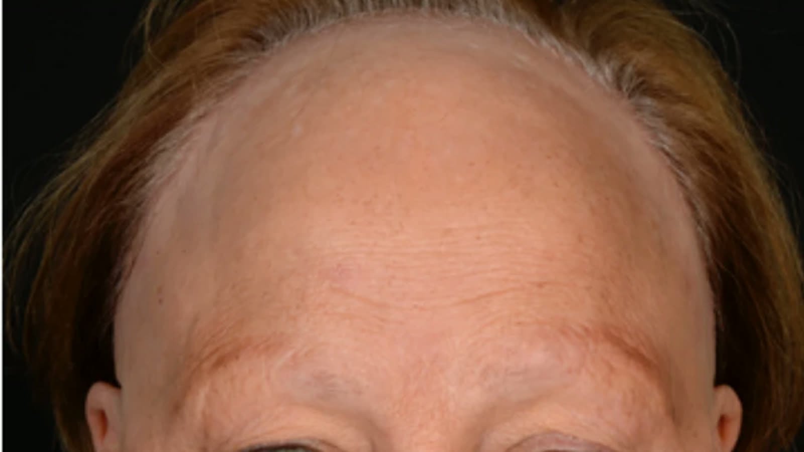 Alopecia frontal fibrosante: a testa que 'aumenta' e as sobrancelhas que somem
