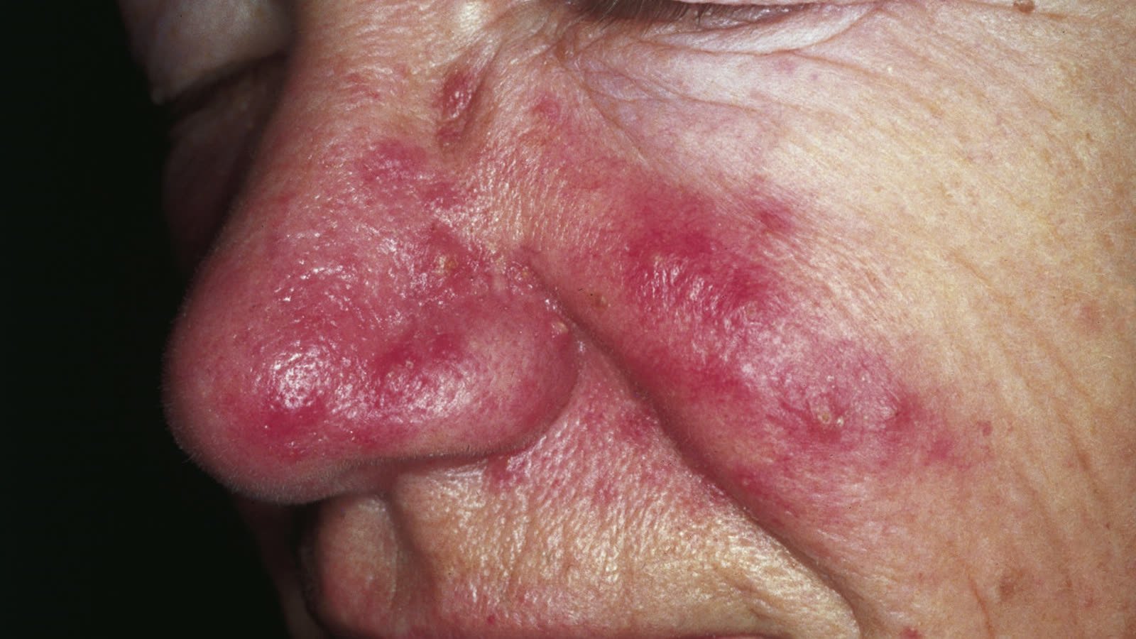 Rosácea não é só vermelhidão: entenda a doença que imita a acne