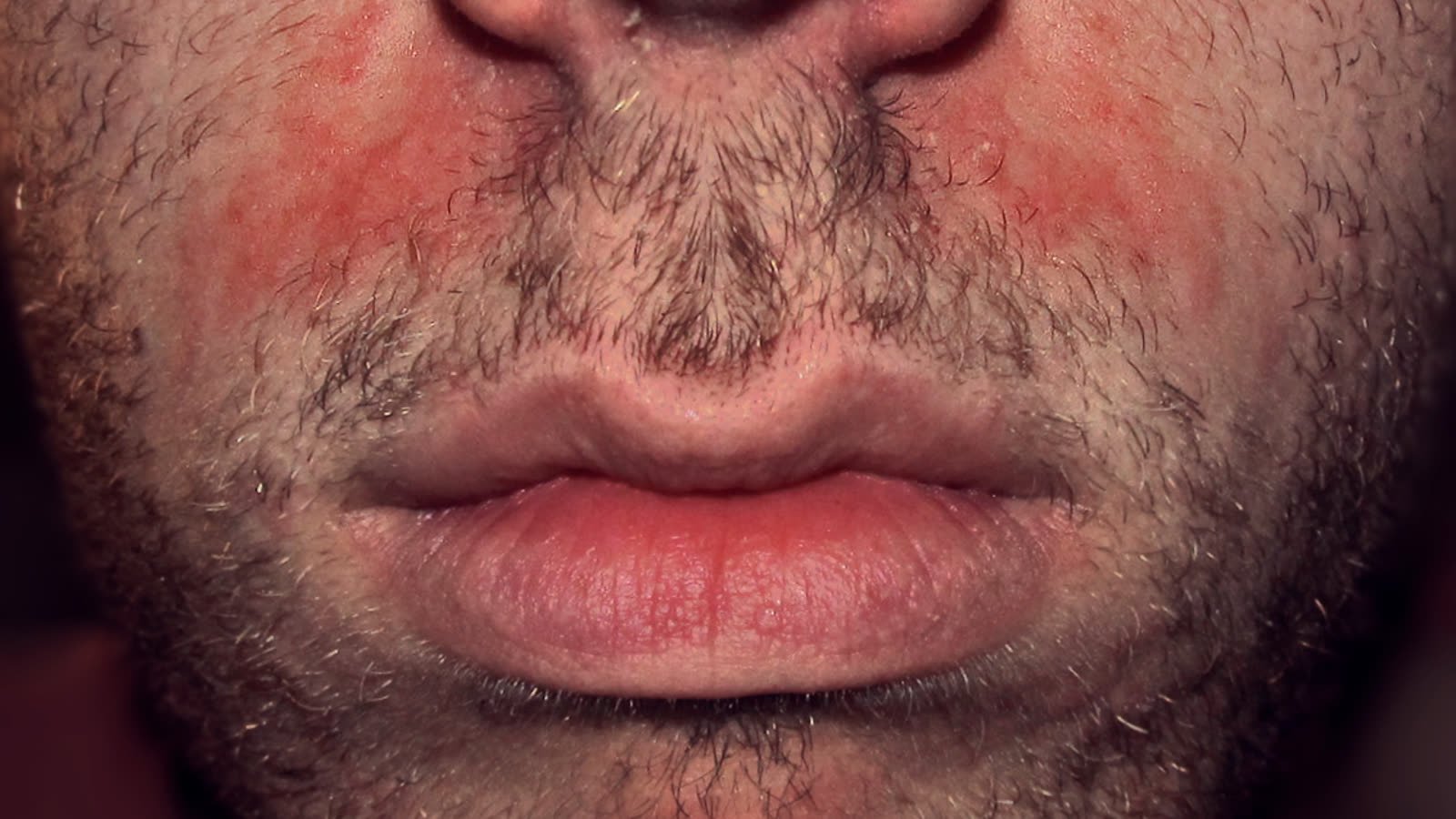 Caspa e dermatite seborreica: por que descama e coça (e o que resolve)
