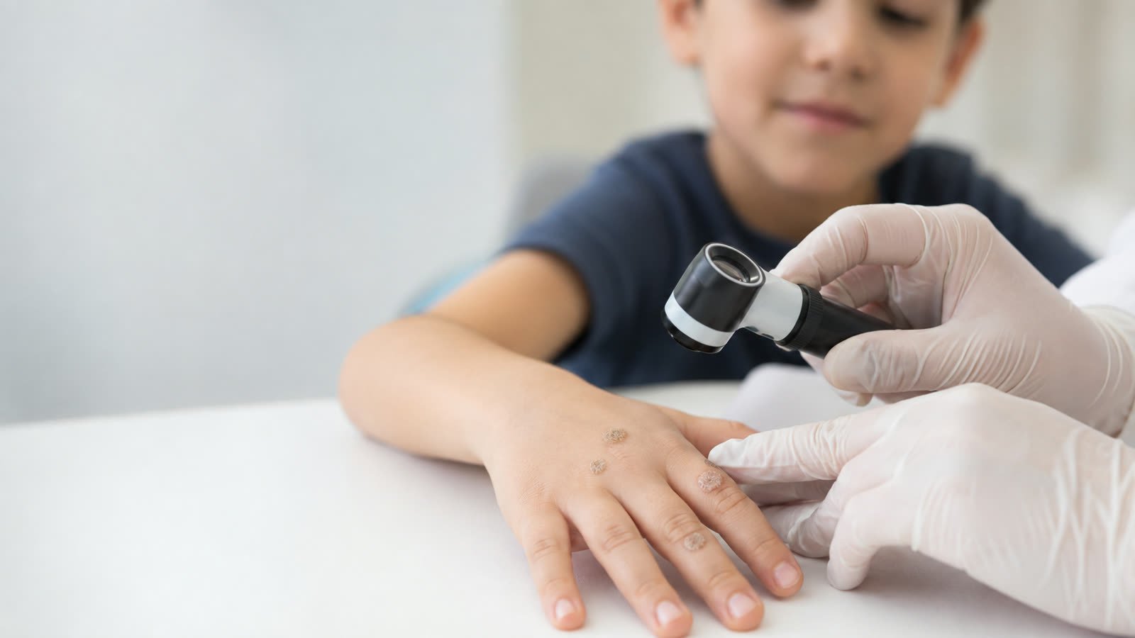 Verrugas em crianças: por que aparecem e quando realmente precisam de tratamento