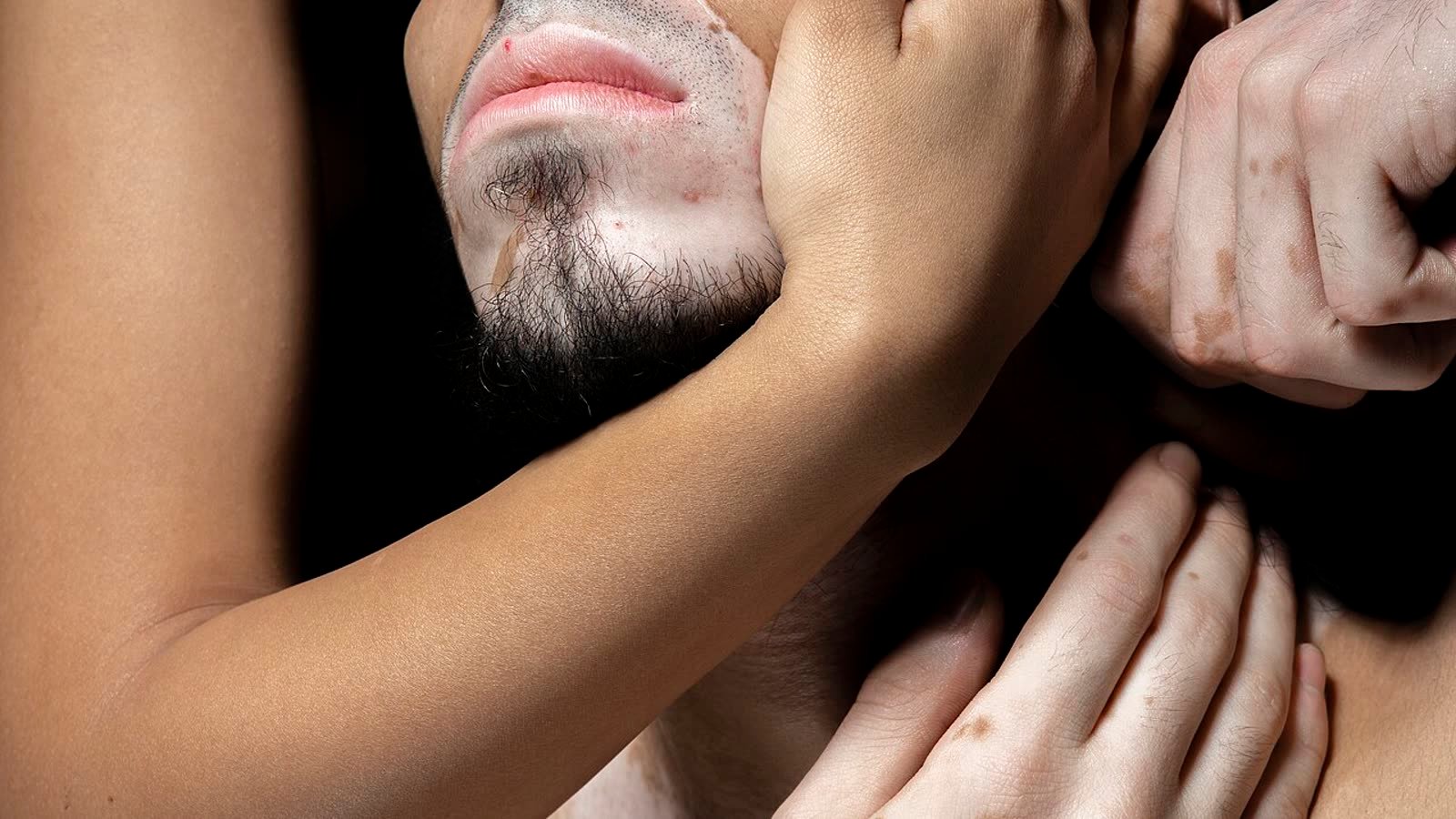 Vitiligo: por que surgem as manchas brancas e o que o tratamento pode fazer