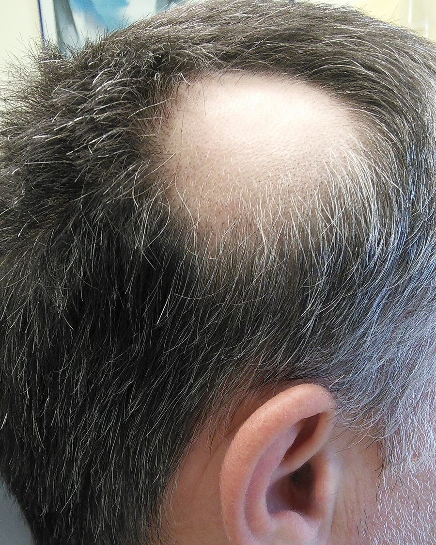 Alopecia areata