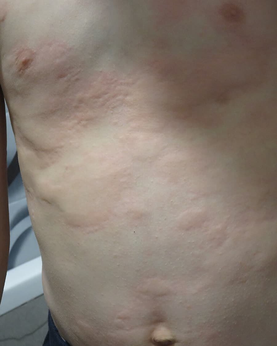 Urticária crônica