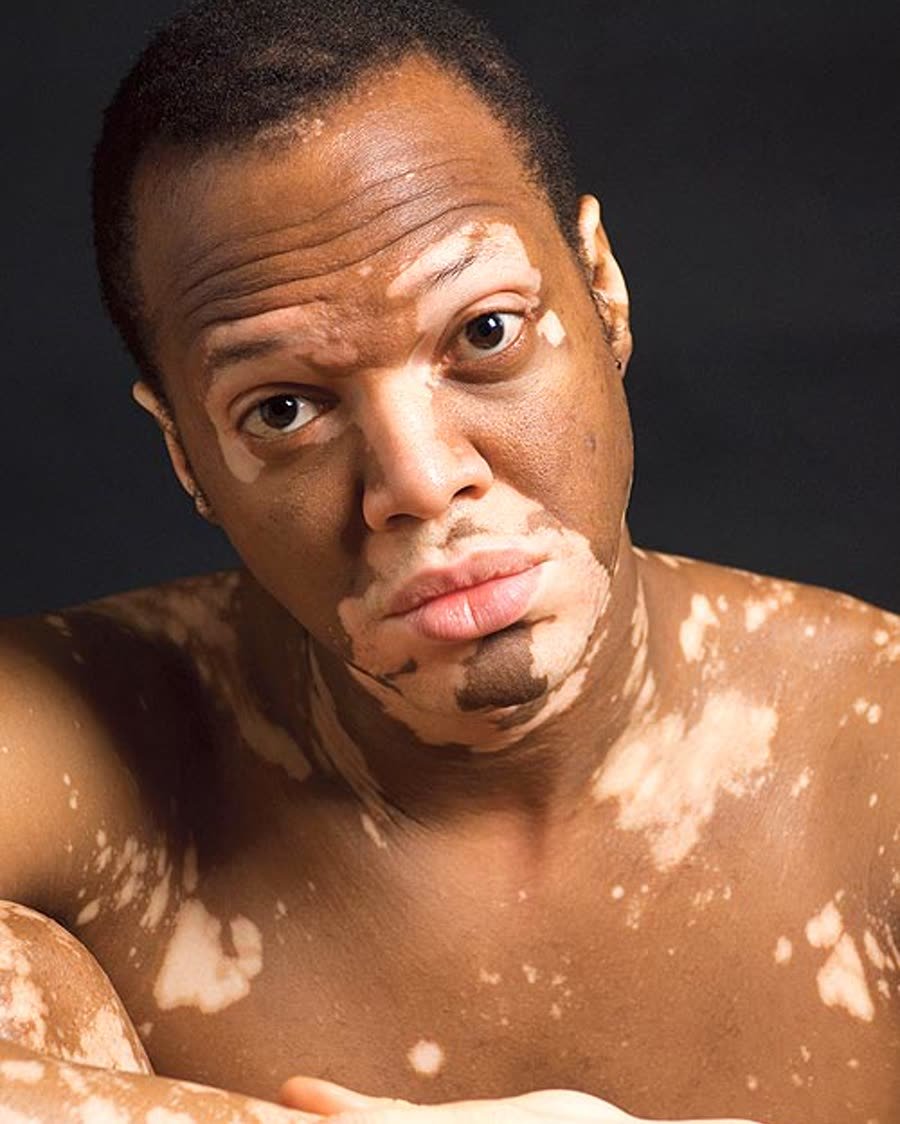 Vitiligo