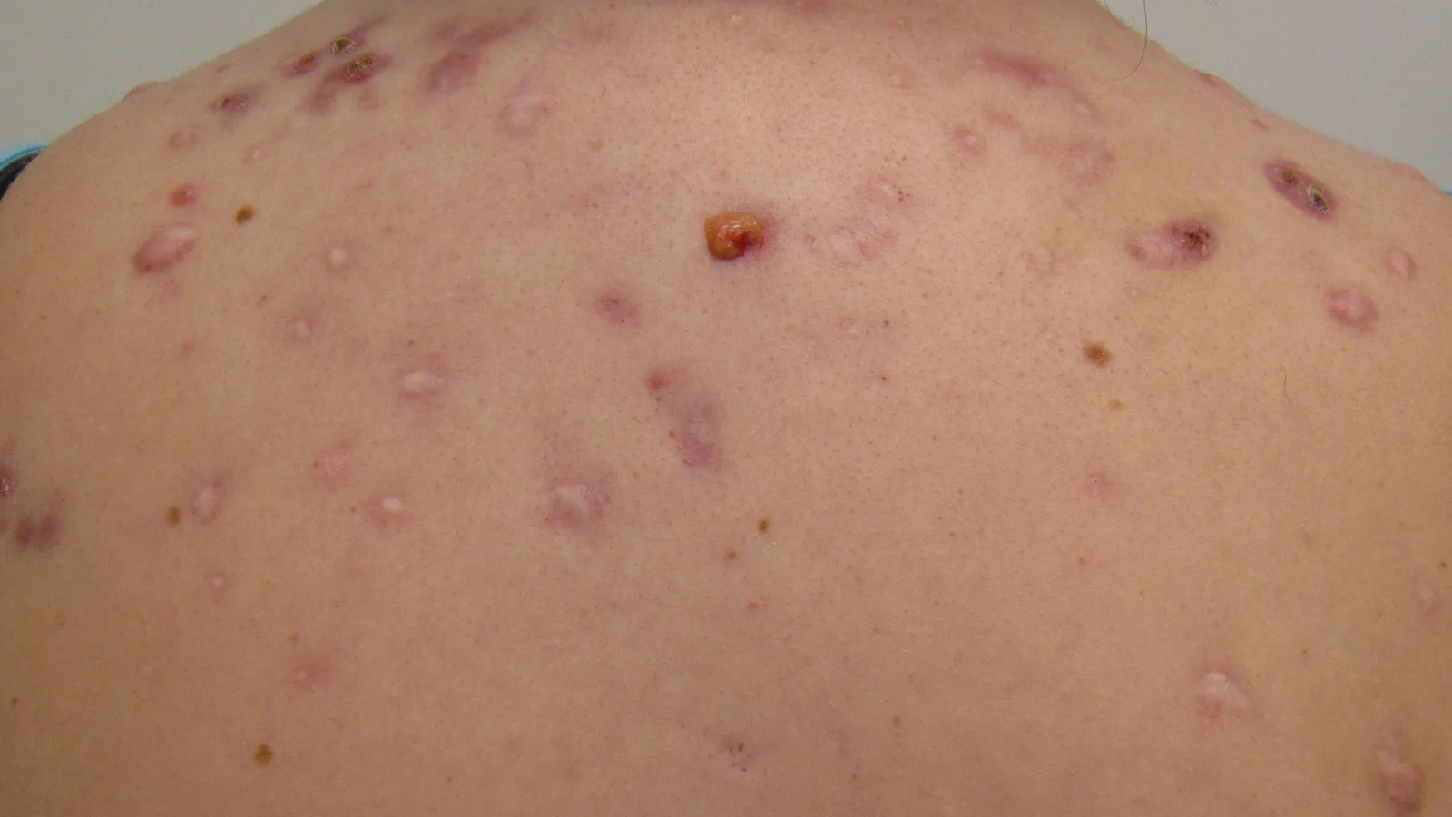 Parte alta das costas de uma pessoa adulta com lesões de acne inflamadas, nódulos e cicatrizes avermelhadas espalhadas pelos ombros.