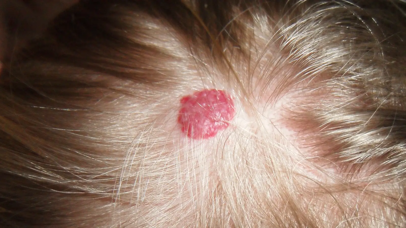 Pequena lesão vermelho-viva, elevada e de superfície irregular, no couro cabeludo de uma criança, entre fios de cabelo claros.