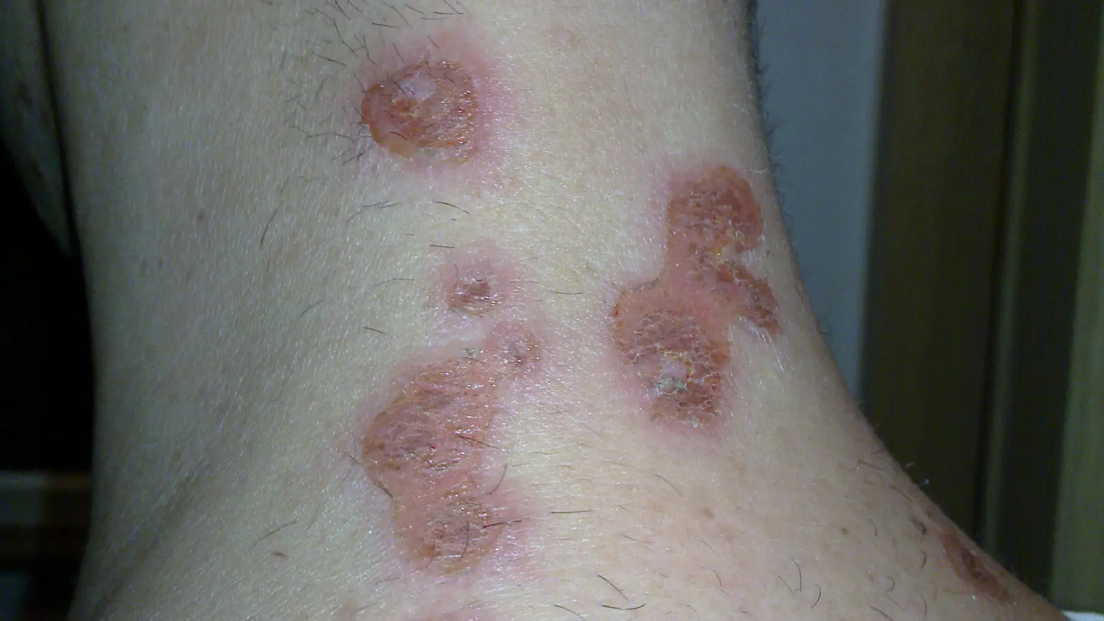 Nuca com várias feridas arredondadas, avermelhadas e cobertas por crostas acastanhadas e amareladas, típicas de impetigo.